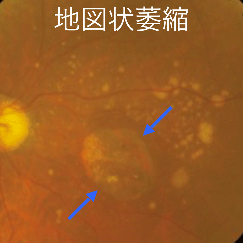 萎縮型加齢黄斑変性症