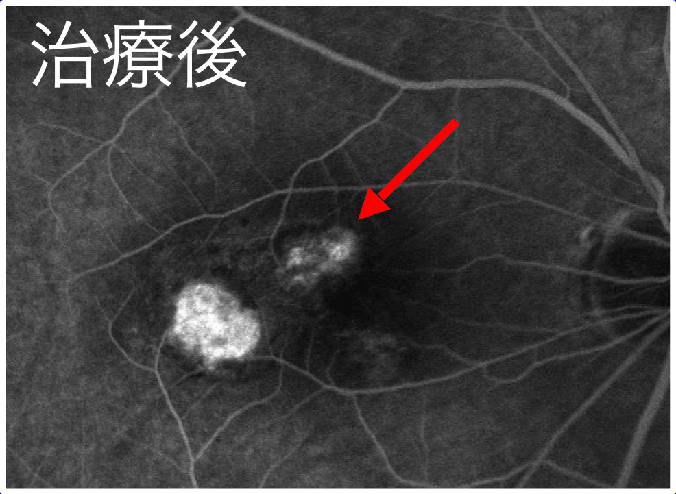 フルオレセイン蛍光眼底造影 治療後