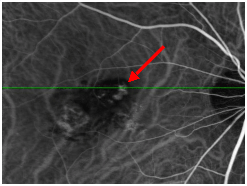 インドシアニングリーン蛍光眼底造影