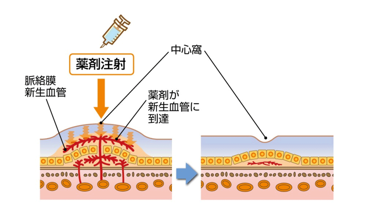 抗血管新生薬療法