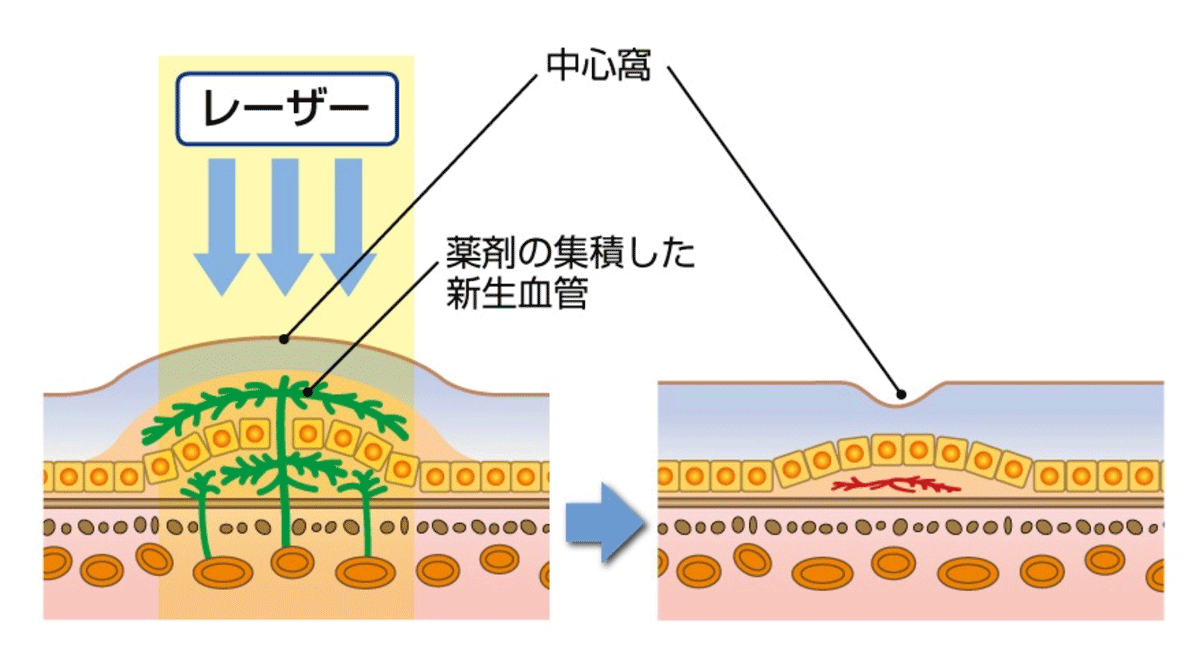 光線力学的療法（PDT）
