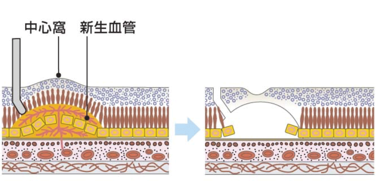 新生血管抜去術