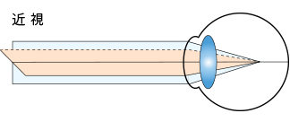 近視