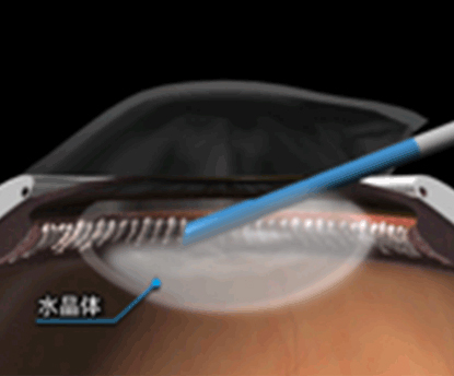 超音波乳化吸引術