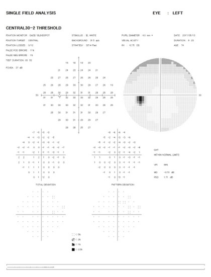 HF30 右眼 緑内障