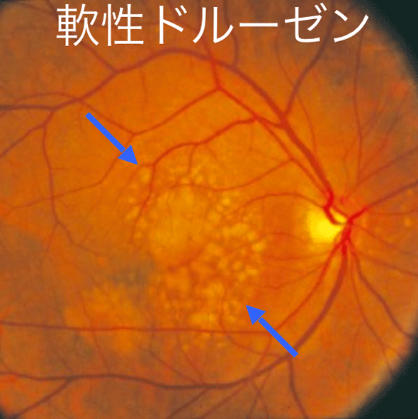 前駆症状