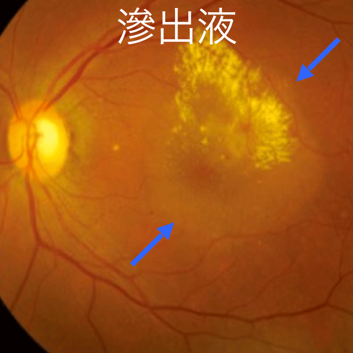 前駆症状