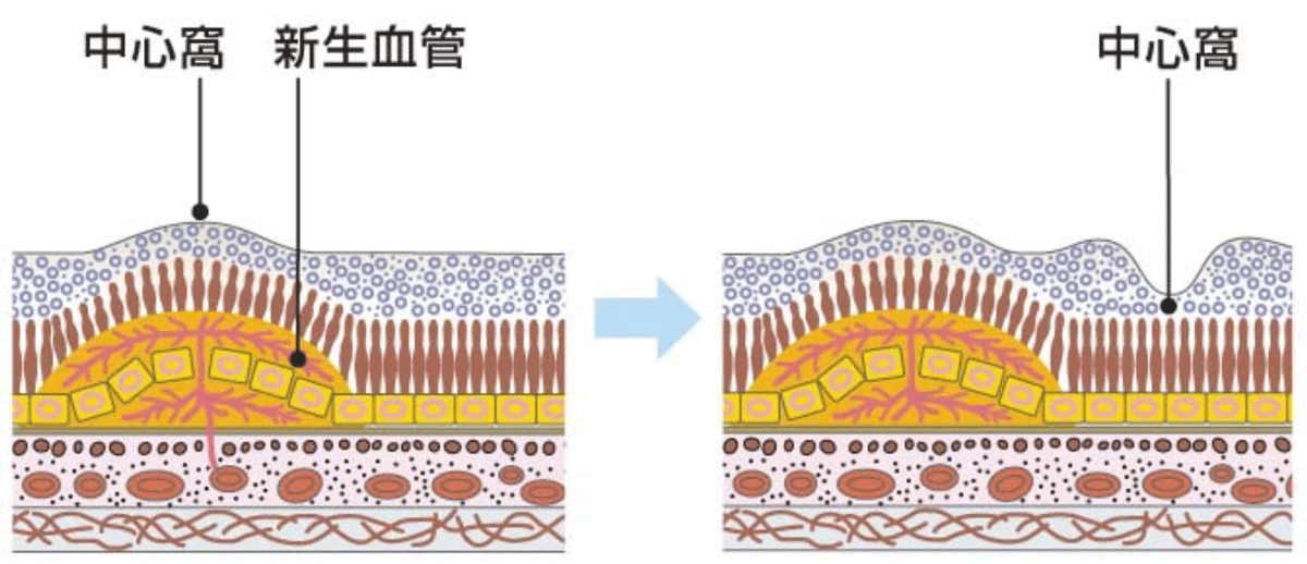 黄斑移動術